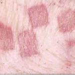 Hiểu biết về bệnh đóng dấu ở heo cùng big boss