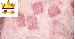 Hiểu biết về bệnh đóng dấu ở heo cùng big boss